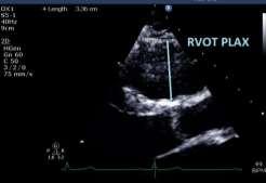 following: - RV EDV/BSA 110 ml/m 2 (male) or 100 ml/m 2 (female) - RV ejection fraction 40% RV angiography criteria Regional RV akinesia, dyskinesia, or aneurysm 2D Echo Criteria Regional RV akinesia