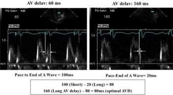 wave on mitral inflow is measured at short and long AV delays.