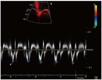 TDI Tissue Doppler imaging of the septal mitral annular velocities (e') Color