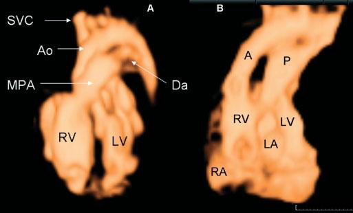 (b) fetus at 26 weeks, showing only one vessel emerging from the ventricles (T) in a case of truncus arteriosus.
