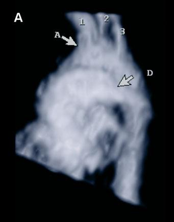(b) B-flow demonstration of right aortic arch (RAA) in anterior view from a fetus at 27 weeks of gestation. The pulmonary artery (P) is in its normal position.