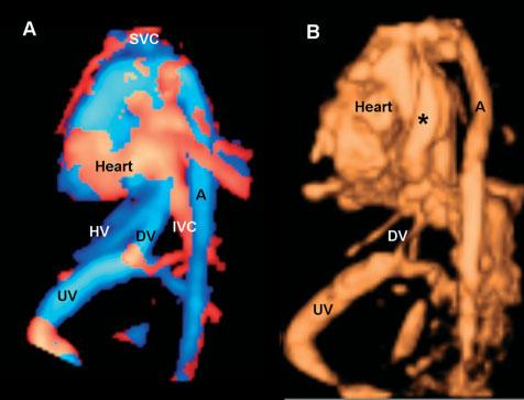 650 L. GINDES ET AL. Figure 7 Lateral views from fetal left side showing veins anatomy (a) rmal fetal veins acquired with high definition Doppler flow STIC from fetus at 22 weeks.