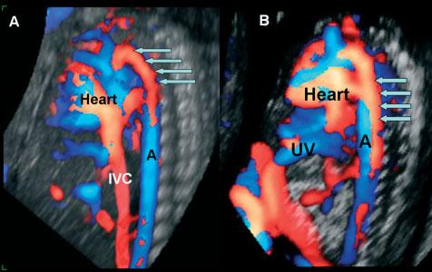 The LPSVC drains into the coronary sinus at the left side of the heart and to the right atrium.