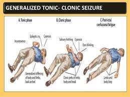 *Different phases of tonic-clonic type of