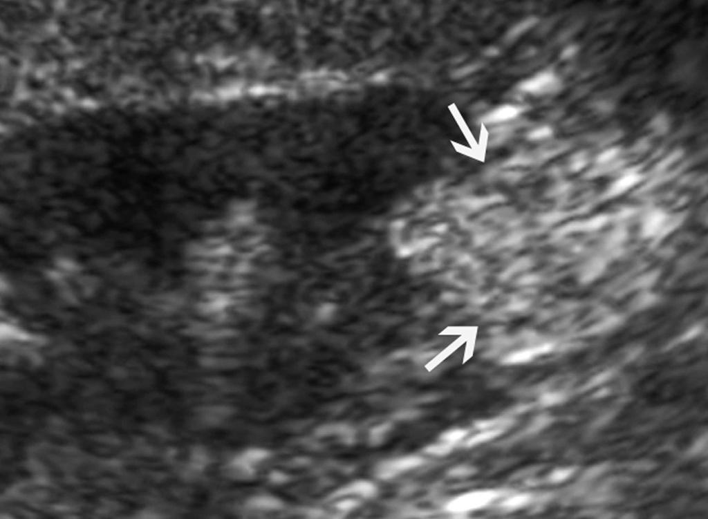 Baseline ultrasonography (A) shows a welldefined mass (arrows) with