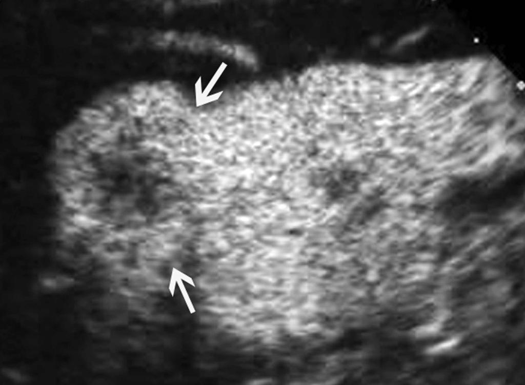 hyperechogenicity relative to adjacent renal parenchyma in the left kidney.