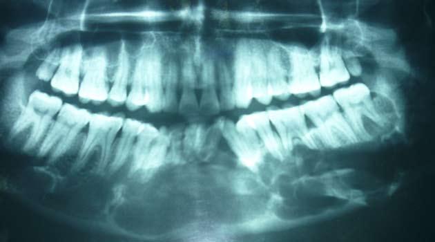 The orthopantomography (OPG) showed well defined multilocular radiolucent lesion in the left angle, body of the mandible, crossing the midline to involve the right body of mandible with thinning of