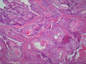 Fig. 3. Histological picture showing features of ameloblastic carcinoma. sign described has been swelling, although others include associated pain, rapid growth, trismus and dysphonia (6).