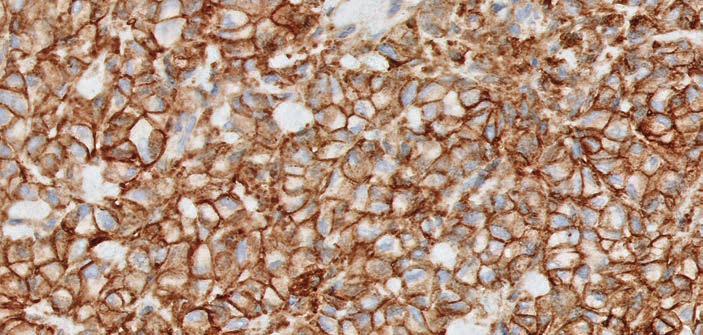 Image Guide for Interpretation of PD-L1 IHC 22C3 pharmdx Staining in Gastric or GEJ Adenocarcinoma PD-L1 Staining Cells Included in the CPS Numerator Tumor cells, lymphocytes, and macrophages