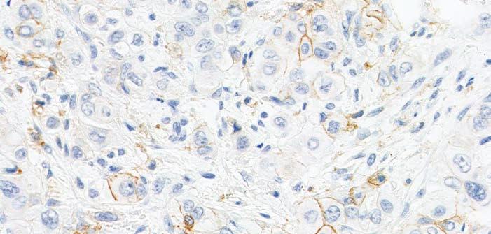 Partial and Complete Linear Membrane Staining Tumor cells and tumor-associated mononuclear inflammatory cells (MICs: lymphocytes, macrophages) can exhibit partial and/or complete linear membrane