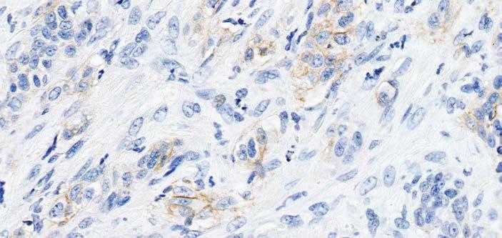 Weak Linear Membrane Staining Tumor cells and tumor-associated mononuclear inflammatory cells (MICs: lymphocytes, macrophages) must exhibit convincing staining at any intensity, including weak 1+