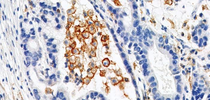 Figure 22c: PD-L1 primary antibody exhibiting linear membrane staining of tumor-associated macrophages (arrows) (20x magnification).