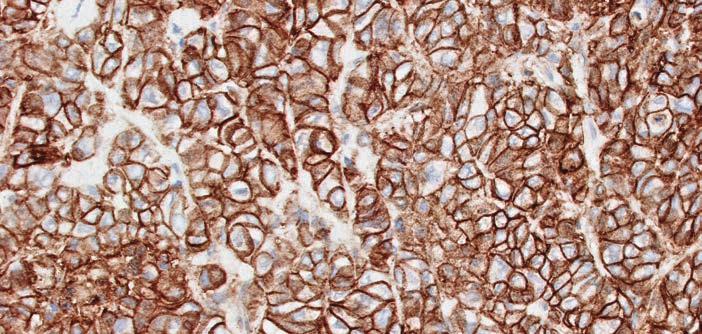 Lattice and Interface Staining Patterns PD-L1 staining tumor cells and tumor-associated mononuclear inflammatory cells can exhibit two distinct staining patterns: lattice and interface.