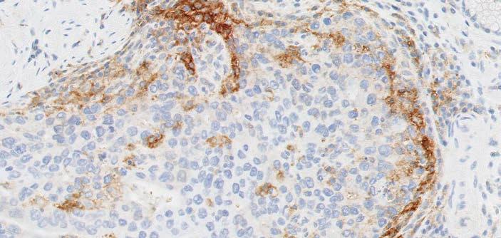 The lattice pattern of PD-L1 staining cells may be partial or complete, and present within tumor nests and/or adjacent supporting stroma. Staining can be present at one or several intensities.