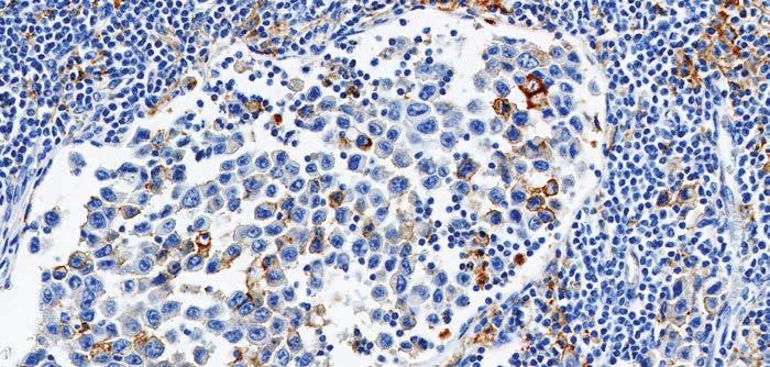 At 20x magnification, any convincing staining of tumor cells and tumor-associated lymphocytes and macrophages at any intensity should be included in the CPS numerator.