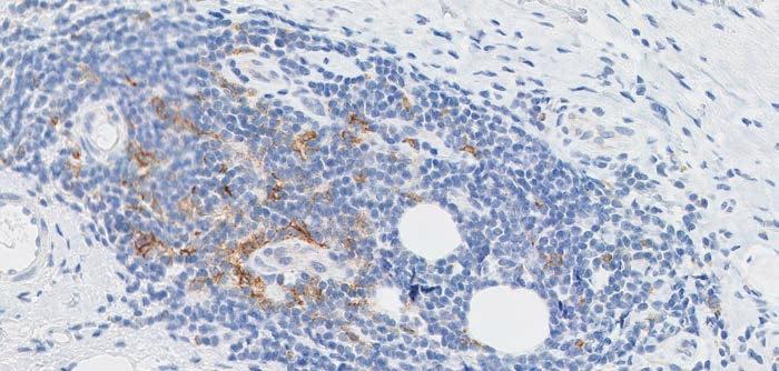 Figure 27d: PD-L1 staining mononuclear inflammatory cells associated