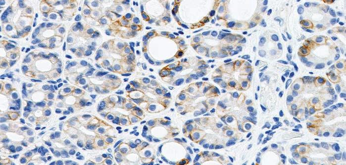 Other Cell Types Excluded from CPS Various other tissue elements can exhibit PD-L1 staining, but only PD-L1 staining tumor