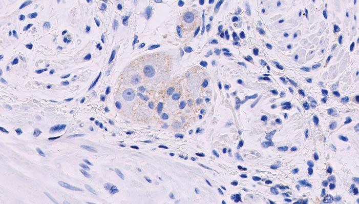 Figure 28c: PD-L1 staining of ganglion cells (arrows) (20x