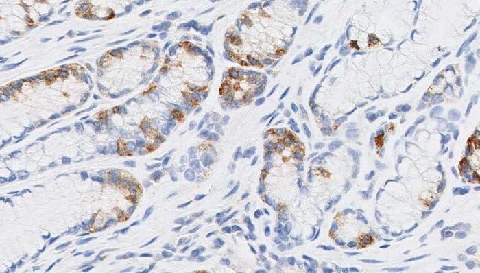 Figure 28d: PD-L1 staining of endocrine cells (20x  Key point