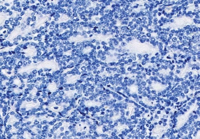 Artifacts The following pages provide examples of artifacts you may see when staining with PD-L1 IHC 22C3 pharmdx.