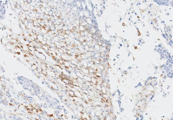 Poor Fixation Standardization of fixation is very important when using PD-L1 IHC 22C3 pharmdx. Suboptimal fixation of tissues may give erroneous results.