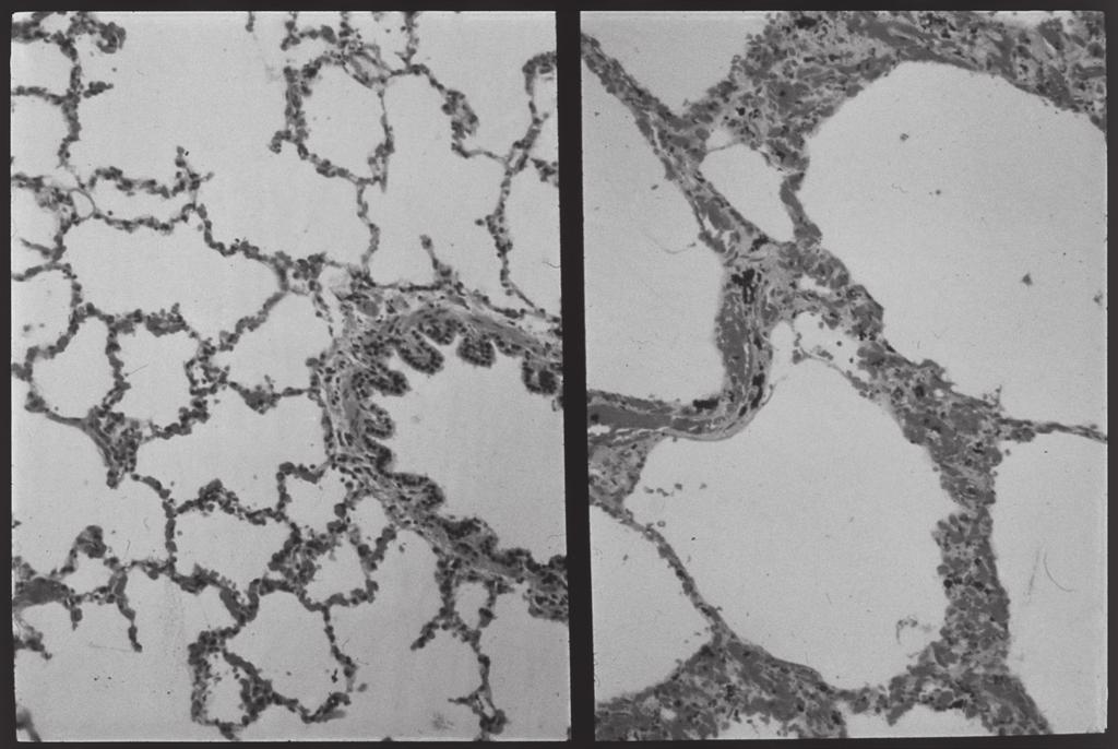 2 Answer all questions. 1 Fig. 1.1A is a photomicrograph of healthy lung tissue. Fig. 1.1B is a photomicrograph of lung tissue from a person with emphysema, a chronic obstructive pulmonary disease (COPD).