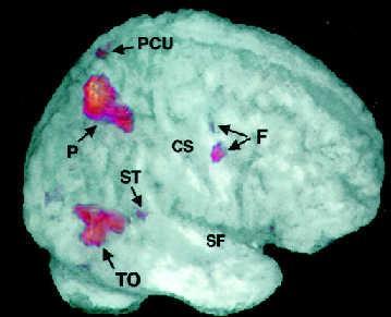 fmri using spatial cueing paradigms Central detection Blocked design: valid & invalid vs.
