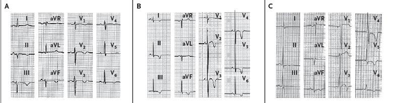 ECG changes might precede phenotypic signs of structural heart disease 24 yrs canoer 26 yrs soccer player 29 yrs soccer player No signs of disease Died suddenly within 1