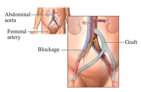 This operation is to bypass the blocked arteries in the leg so that the blood supply is improved. If the surgery is successful, it should allow you to walk further without pain.