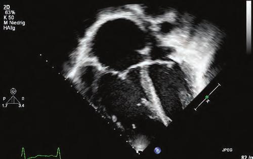The end-systolic septal bowing is typical for pulmonary arterial hypertension (PAH). Remodeling of left and right cavities in a 14-year-old patient with severe idiopathic PAH.