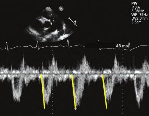 39-42 The RVOT VTI can be obtained by placing a PW Doppler sample volume in the proximal RVOT just within the pulmonary valve when imaged from the PSAX view. Vlahos et al.