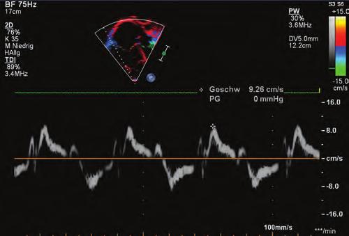 Systolic and diastolic duration was measured, using TR duration, by continuous-wave Doppler from the apical 4-chamber view to calculate the S/D ratio.