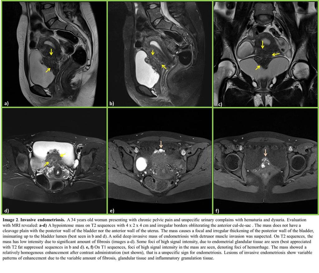 Fig. 2: Infiltrative deep endometriosis of the anterior cul-de-sac involving the bladder and