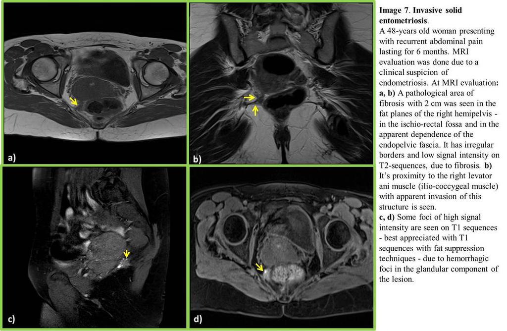 Fig. 7: Infiltrative endometriosis of the left ischiorectal fossa Department