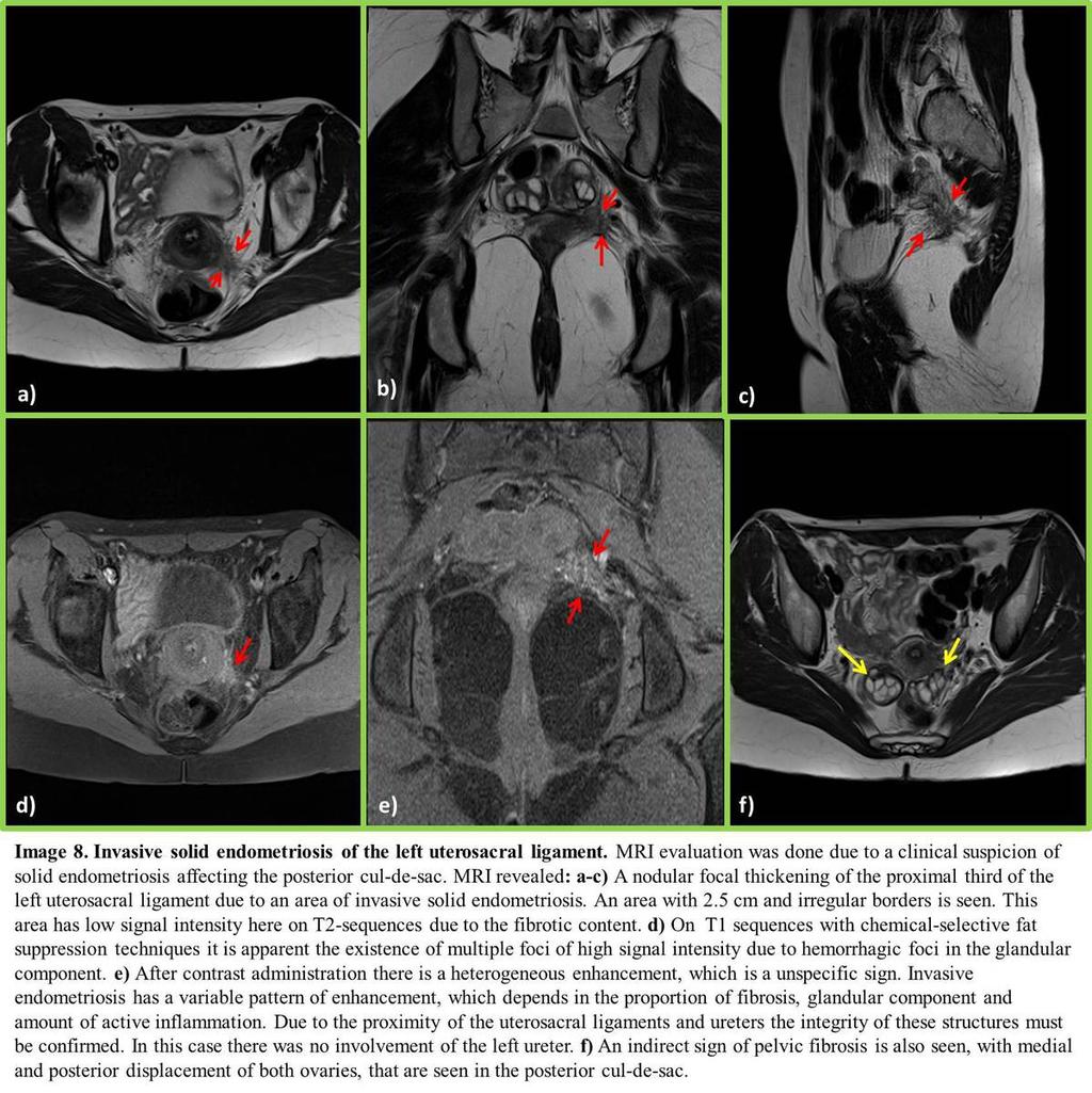 Fig. 8: Deep solid endometriosis of the posterior compartment involving the uterosacral
