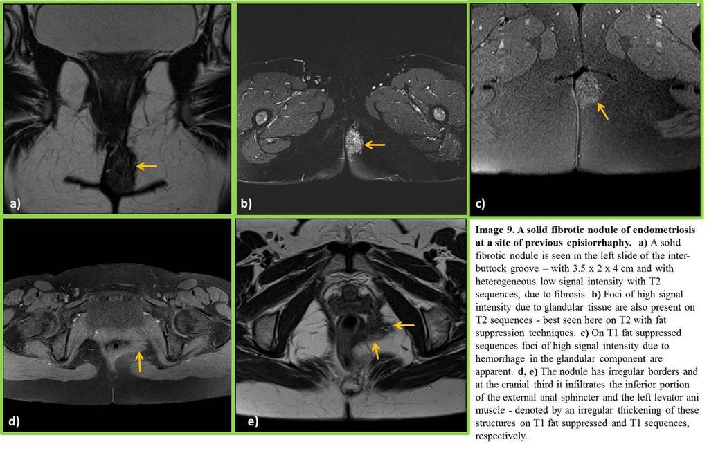 Fig. 9: Deep solid endometriosis at the site of previous episiorrhaphy