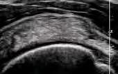 Interspersed Connective tissue(not tear) Tendon fasicles