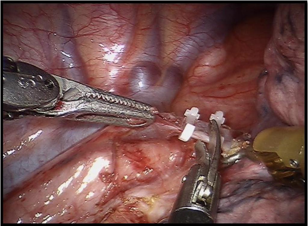 PART I 4 Figure 3. Clipping and dissection of the azygos vein Paratracheally left, the left recurrent nerve is identified and carefully protected.