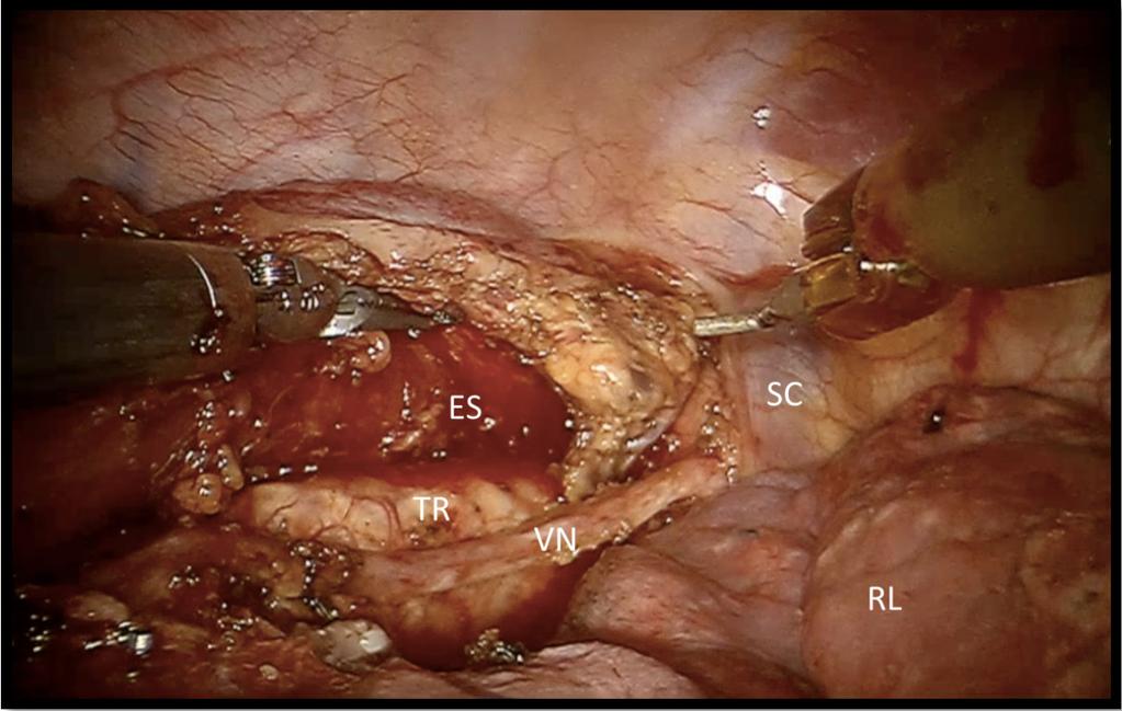 PART I 4 Figure 6. Upper mediastinum. Legend. ES: Esophagus, VN: Vagal Nerve, TR: Trachea, RL: Right Lung, SC: Subclavian Artery.