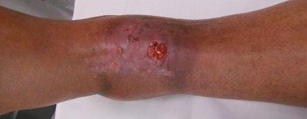 Figure 12.1. A 61-year-old patient with chronic periprosthetic ankle joint infection.