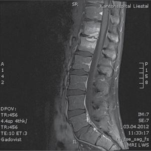 .1. A 20-year-old man with hematogenous vertebral osteomyelitis due to Salmonella enterica subsp enterica Tennessee.