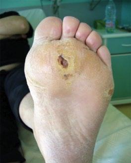 in a diabetic foot patient; the trocard is introduced through a noninfected skin area opposite to the