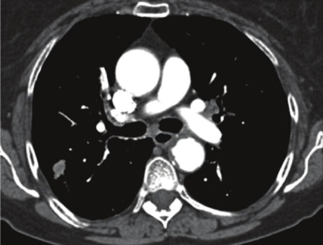 GROUP 1: Including: Excluding: Peripheral tumour with normal hilar and mediastinum on staging CT with no disant metastases Solid pulmonary nodules 8mm diameter / 300mm3 volume and BROCK risk of