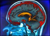 Primary Brain Tumors Benign: take it out!