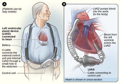 Mechanical circulatory support Stage D heart