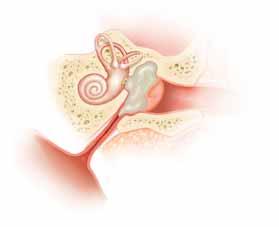 OME Otitis media with effusion occurs when middle ear fluid becomes trapped behind the eardrum. This fluid may become thick and sticky and take a long time to clear up. OME is rarely painful.