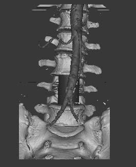 The virtual simulation operation is very direct and accurate to reconstruct three-dimensional structure of affected vertebrae and adjacent organs, to define the range of affected lesions, and is