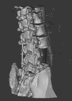 Virtual simulation surgery of vertebral metastases provides surgeon more objective information, to help them adopt the individual strategy for every patient.