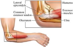 Summary of Cross-Sectional Views Dense fibrous common extensor origin Blends with joint capsule and annular ligament No comparable fibrous origin medially 41 Tennis Elbow: Demographics Age 30 50