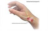 Tendonitis About the Wrist DeQuiervain s Intersection Syndrome ECU tendonitis FCU